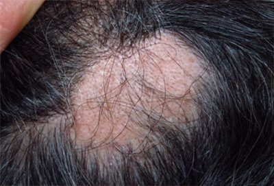 Alopecia Areata - Ayurvedic Hospital in Kota