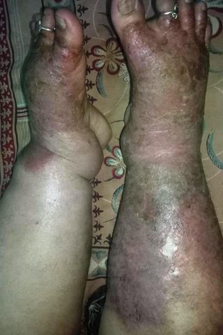 Eczema - Ayurvedic Hospital in Kota